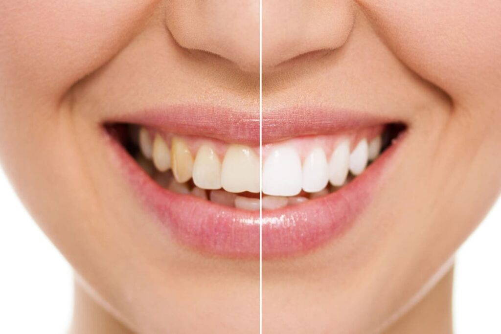¿Cómo se realiza un blanqueamiento dental?, %sitename%