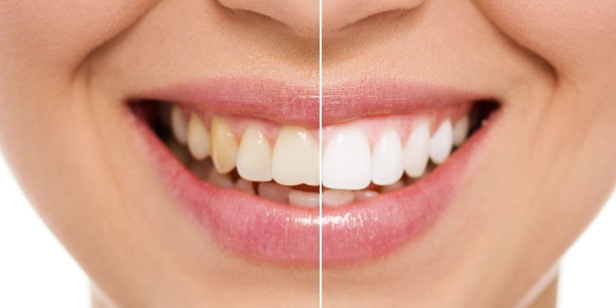 ¿Cómo se realiza un blanqueamiento dental? ¿Cómo se realiza un blanqueamiento dental?, %sitename%