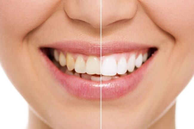 ¿Cómo se realiza un blanqueamiento dental?,  %sitename%