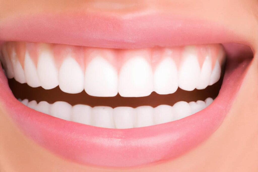 ¿Cuál es el mejor tratamiento para blanquear los dientes?